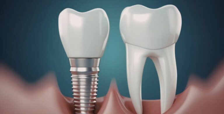 Smile Restoration in Pearland: The Power of Implant-Supported Bridges