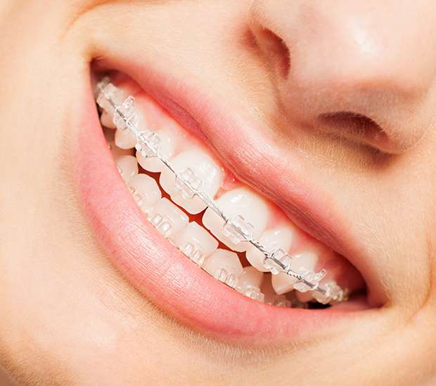 Pearland Clear Braces