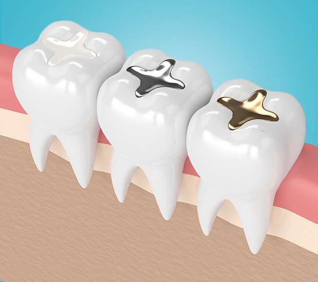 Pearland Composite Fillings