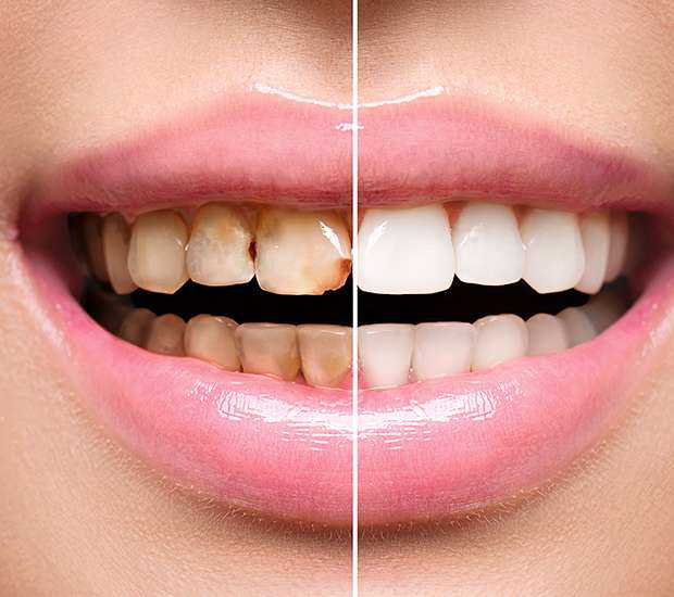 Pearland Dental Implant Restoration