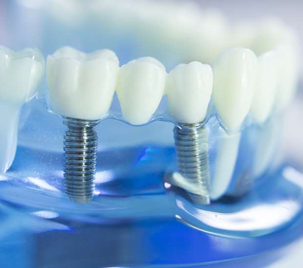 Pearland Dental Implants