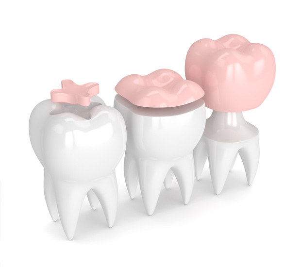 Pearland Dental Inlays and Onlays