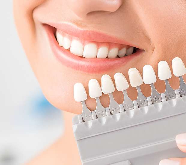 Pearland Dental Veneers and Dental Laminates