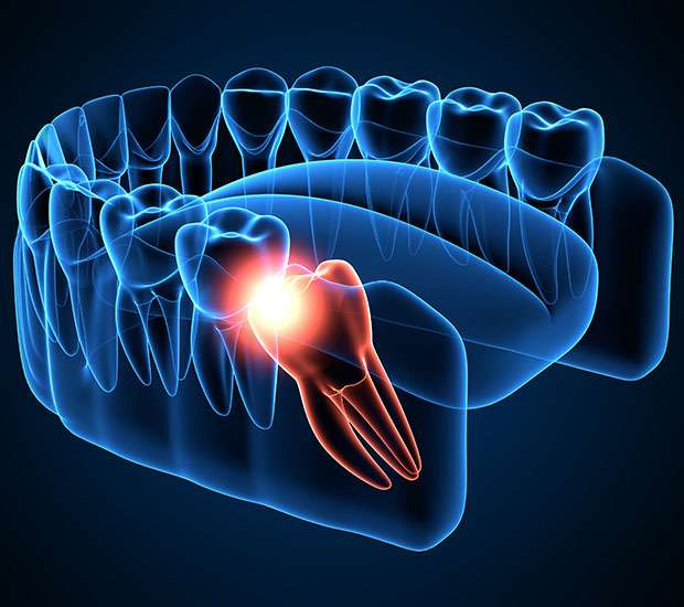 Pearland Wisdom Teeth Extraction